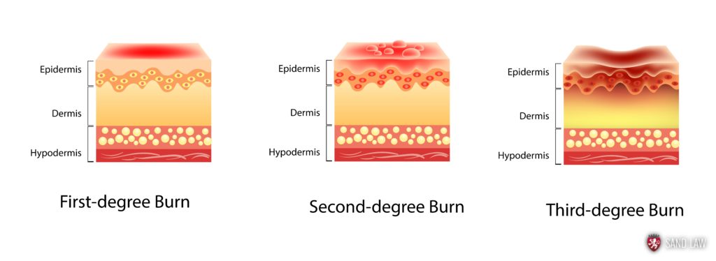 Burn injury degrees - sand law llc